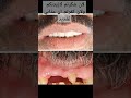 قرآن كريم القرآن الكريم منصور السالمي تركيبات الاسنان أسنان