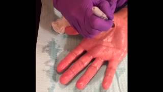 Using Botox for Excessive Sweating on Palms & Under Arms - Dr. Mir