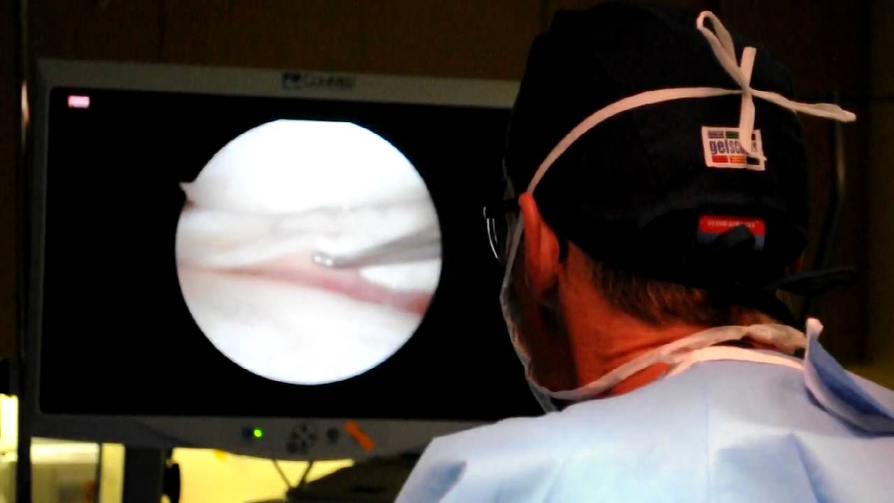 Dr. Robert Eppley Arthroscopic Knee Surgery Video 1 YouTube