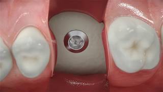 Straumann® BLX  Conventional posterior implant placement