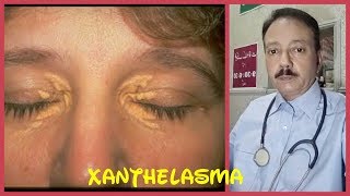 XANTHELASMA TREATMENT HINDI I FATTY DEPOSITS UNDER EYES I XANTHELASMA HOMEOPATHIC TREATMENT