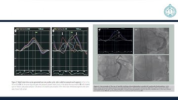 Speckle tracking and strain echo