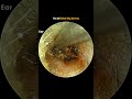 The Stickiest Oily Earwax Ever