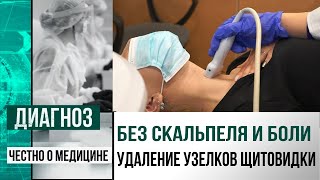 Что такое радиочастотная абляция и как удалить опухоль щитовидной железы без операции | Диагноз