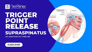 Trigger Point Release - Supraspinatus