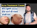 Acne treatment  acne treatment cream  acne cream review  medishan medicos