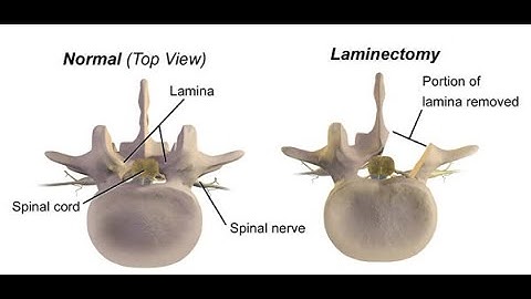 Laminotomy with decompression of nerve root CPT code - simplify medical coding