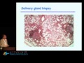 Update on Sjogren's syndrome: from pathogeny to treatment - Xavier Mariette, M.D., Ph.D.