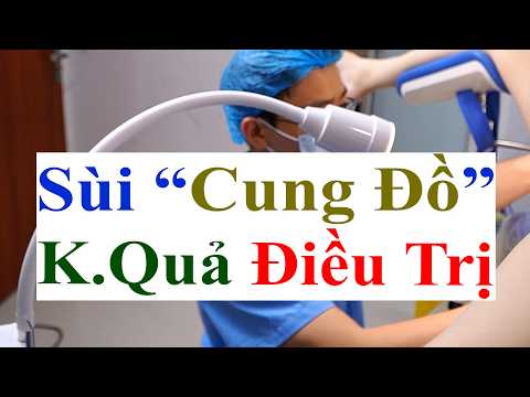 Sùi Mào Gà Rất Nặng Sâu Trong Cung Đồ | Kết Quả Trước & Sau Điều Trị Bằng Đốt Điện Tại PK Bs Sắc