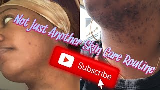 Not Just Another Skin Care Routine | PCOS | Laser Hair  Removal | results and pictures | what I use