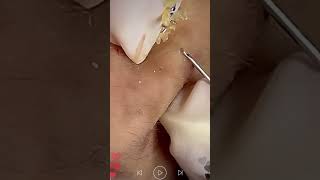 Acne Treatment & Blackhead Removal Very Satisfying Pimple Popping