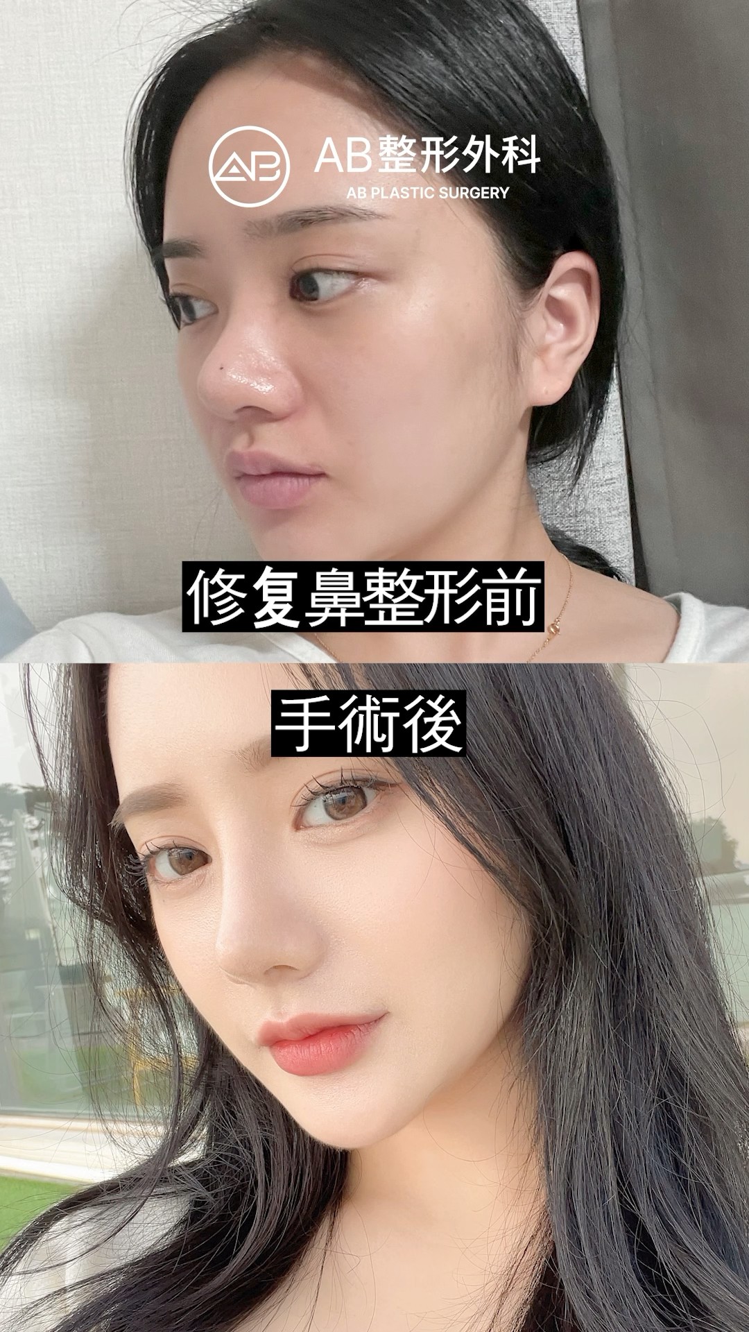 她的鼻子再手術後，美得像韓國明星! #shorts