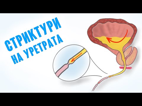 Стриктури на уретрата и трудното уриниране