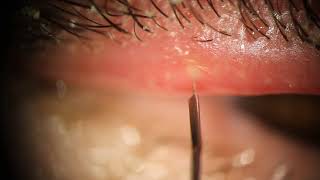 Maskin Probe to Drain Stye Pus at 3:02 and Demodex Removal