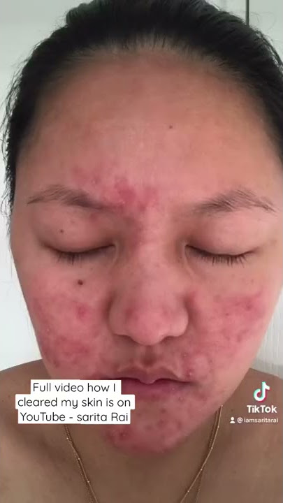 Cleared Rosacea naturally before & after #clearskin