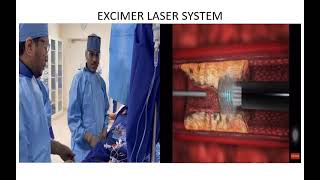 ELCA LASER PCI   —EXCIMER LASER CORONARY ANGIOPLASTY #chennai #interventionalcardiology #angioplasty