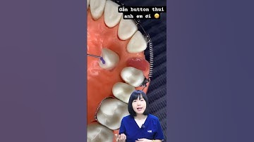 Gắn button để kéo răng chỉnh nha nào | Dr Anh Thư
