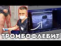 Тромбофлебит по всей ноге. Осложнения ВАРИКОЗА. #shorts​