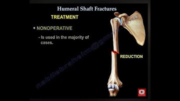 Humerus Fractures - Everything You Need To Know - Dr. Nabil Ebraheim