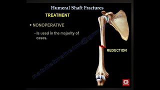 Humerus Fractures - Everything You Need To Know - Dr. Nabil Ebraheim