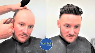 This Is Me! Before & After | Hair System | Non-Surgical Hair Replacement System Men/Women | UK/USA