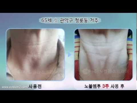 노블엠투에스 사용 전후 비교