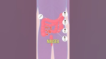 Diverticulitis and Polyps in 3D Animation