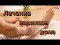 Лечение варикоза в домашних условиях / Treatment of varicose veins at home