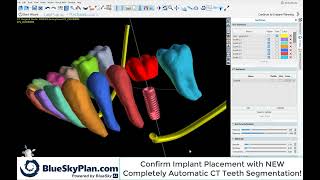 BSP4.11 AI Automatic Implant Placement (1Min)