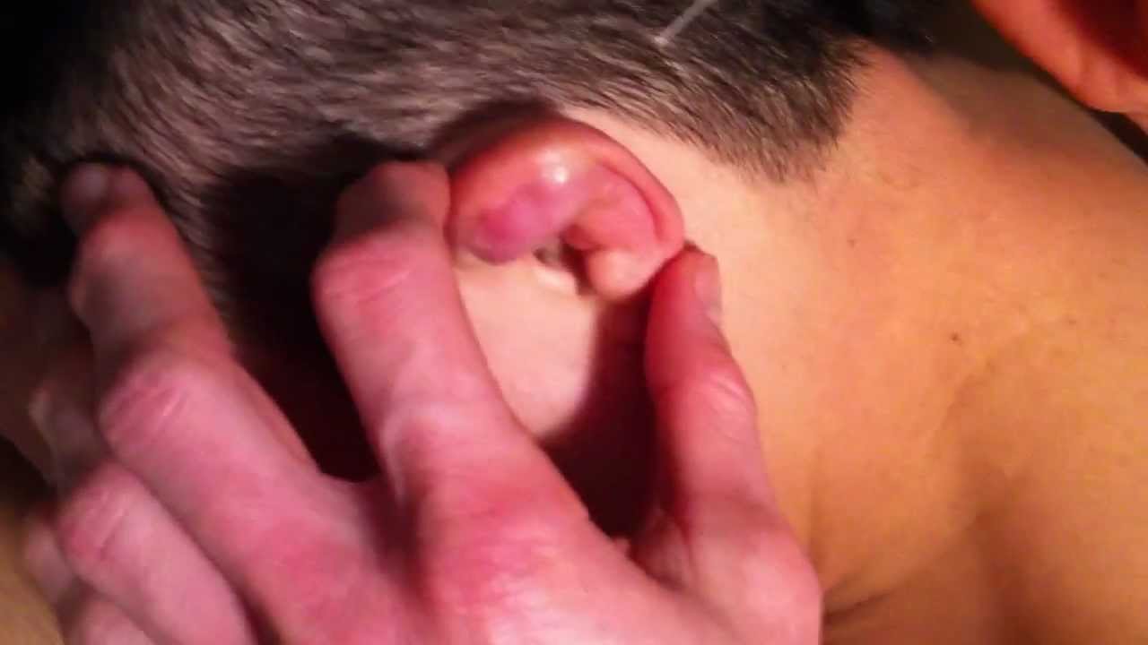 Massive Cauliflower Ear Drain - YouTube