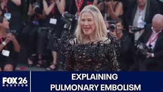 Explaining pulmonary embolism Catherine O Hara s cause of death