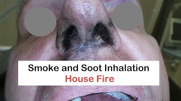 Smoke and Soot Inhalation