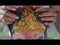 So Much Big Flakes With Acne In Front Side!! - Dandruff Satisfying And Picking #214