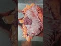 Colon Polyp-rectal bleeding, Anaemia, Weakness 3yrs #coloncancer #cancersurvivor #cancertreatment
