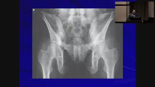 Pelvic and Acetabular Fractures - Anthony Spinnickie, MD