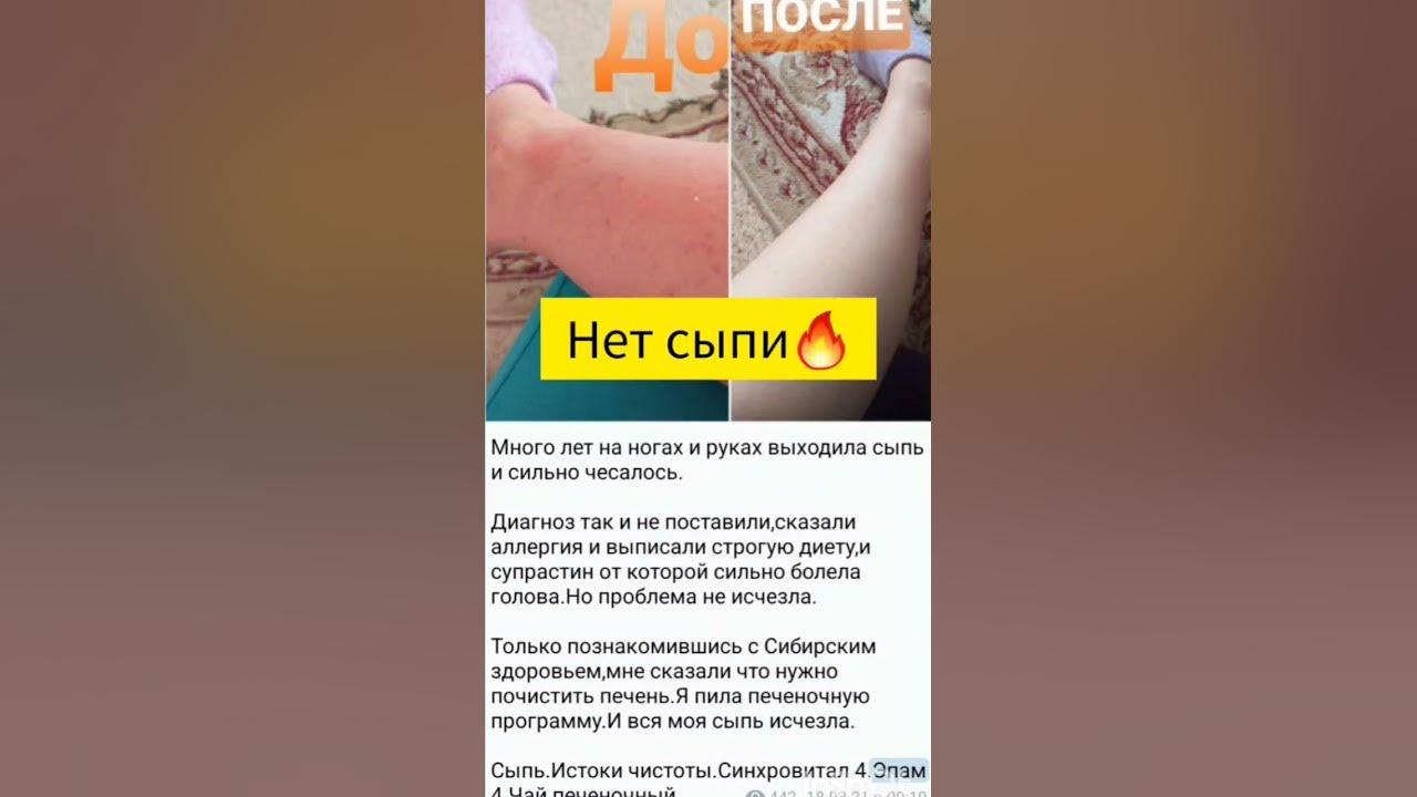 нет сыпи🔥#синхровитал4#эпам4 #здоровье #польза #иммунитет - YouTube