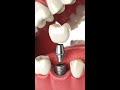 Can dental implants become loosened?