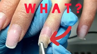 ⚡ONYCHOLISIS of FINGERNAILS😱 Onycholysis of the nails!😲 Nail exfoliation😐