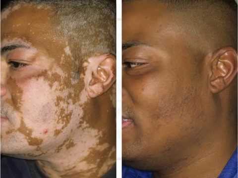 Vitiligo Before &amp; After Treatment - YouTube