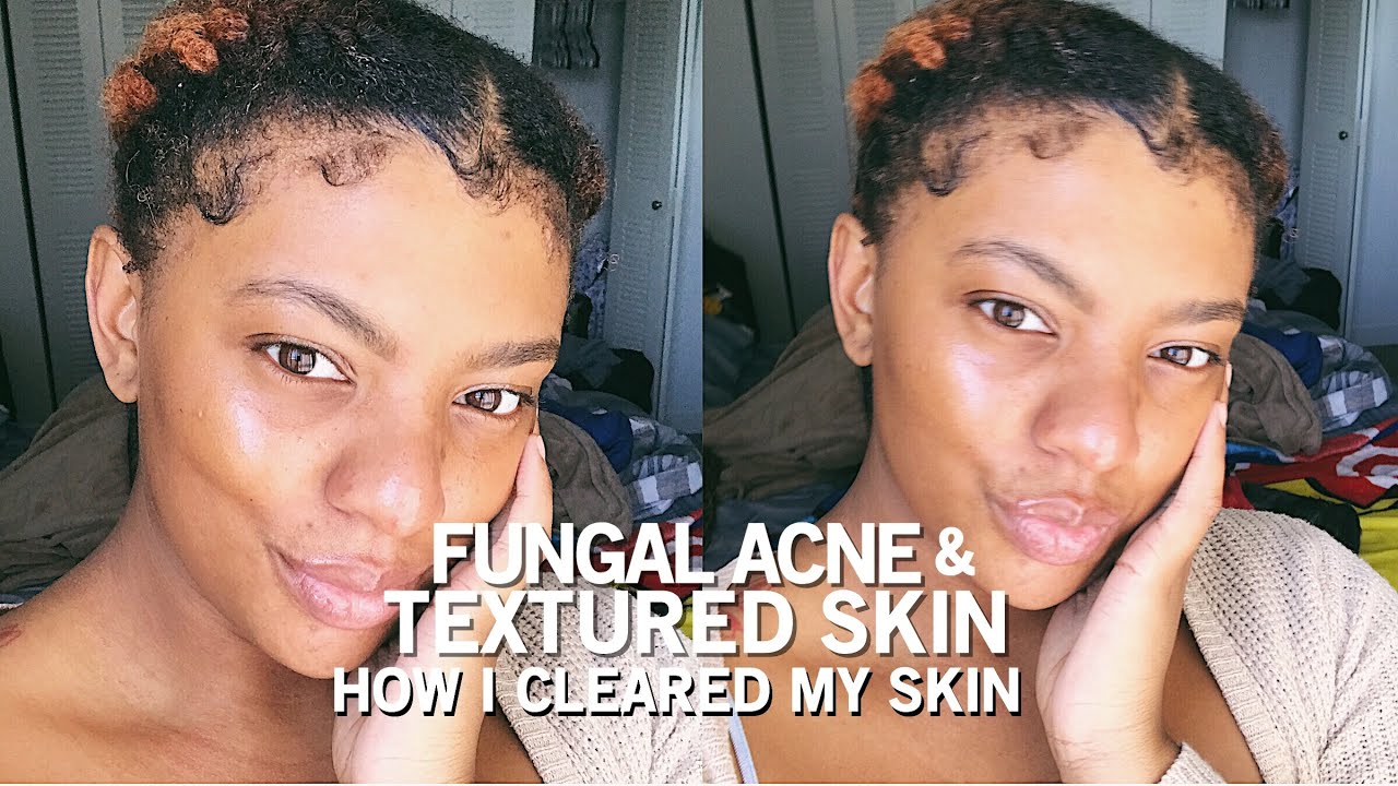 how i got rid of textured skin & fungal acne | oily skin friendly ...
