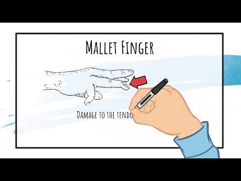 Video: Ako zaobchádzať s prstom Mallet s dlahou: 10 krokov (s obrázkami)