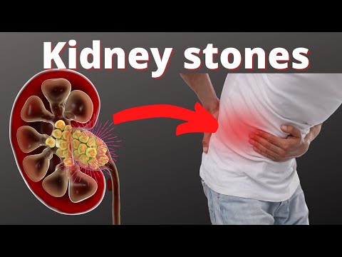 How long does it take to pass a kidney stone from the ureter?