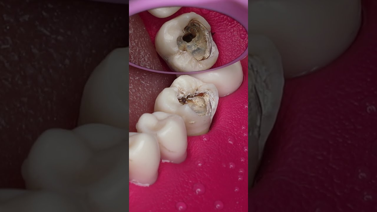Dentist Looking Tooth Cavity Satisfying