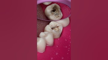 Thumbnail of Dentist Looking Tooth Cavity #dentist #satisfying