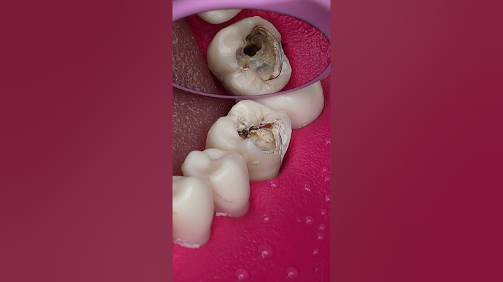 Dentist Looking Tooth Cavity #dentist #satisfying