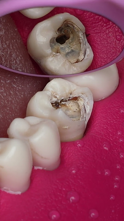 Dentist Looking Tooth Cavity #dentist #satisfying