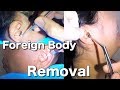 Removal of Foreign Body Stuck from People's Ears Compilation