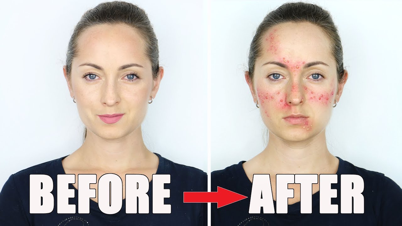 HOW TO MAKE ACNE Makeup Tutorial  / HalloweenXTRA 3 (2017)