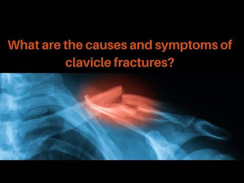 Video: Clavicle pain - the most common causes and treatment