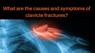 What are the common causes and symptoms of a clavicle fracture?